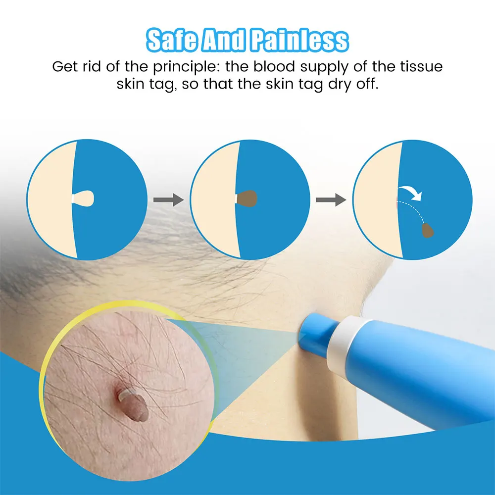 مجموعة أدوات إزالة علامات الجل - مراجعة Acne Light Therapy Pen وسعره