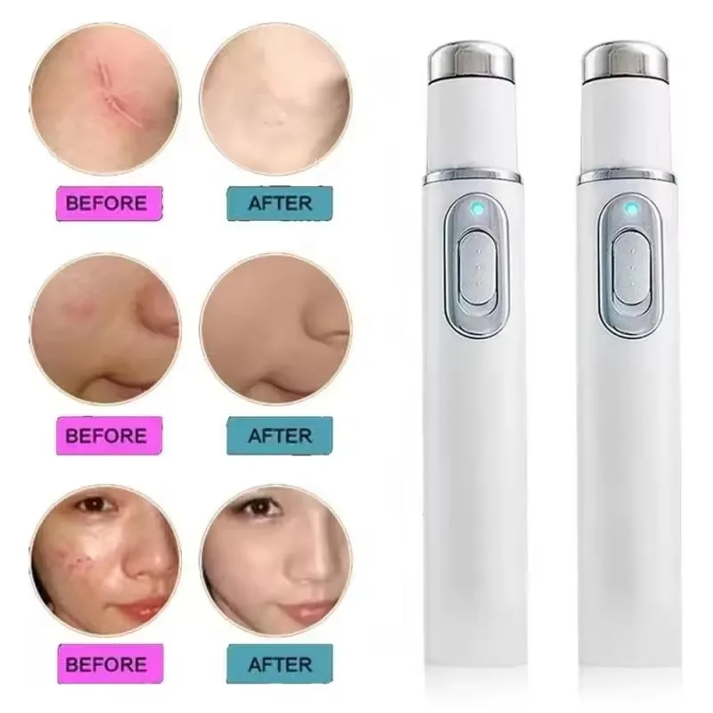 قلم حب الشباب العلاجي بالضوء ا - مراجعة Acne Light Therapy Pen وسعره